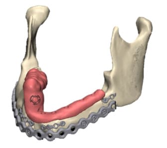 guia para implante dental